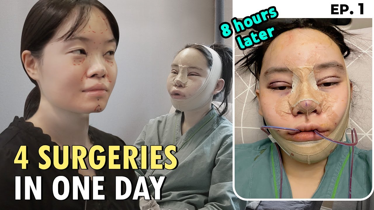 Sub I Got A Full Face Plastic Surgery In Korea Vlog Facial