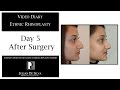 6 Ethnic Rhinoplasty Video Diary  Day 5 After surgery