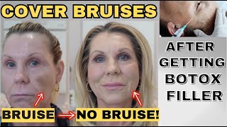 Cover Up a Bruise With Makeup! Getting Injectables Often Causes Bruising; Here's an Easy Fix!