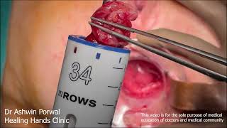USA Case STARR surgery for Rectal Prolapse | Stapled Trans Anal Resection | Rectocele | Constipation