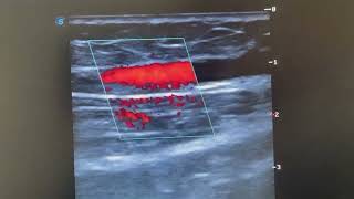 Vein Clinic | Great and Small Saphenous Vein Scan | HHC Clinics