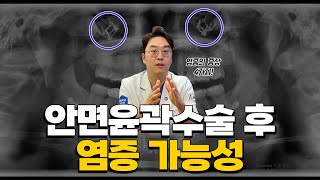 안면윤곽(광대, 사각턱, 턱끝) 수술 후 염증이 일어날 확률은?