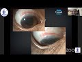 Simplifying bacterial #keratitis treatment with high concentration levofloxacin 1 5%Case -Dr Manisha