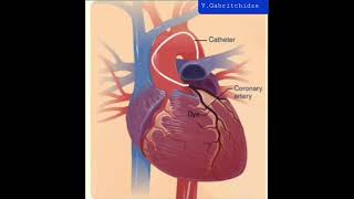 Koronari Angiography- Stends- კორონარული ანგიოგრაფია- სტენდირება