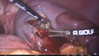 Laparoscopic Unroofing of a Splenic Cyst