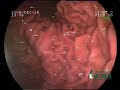 endoscopically assisted gastropexy technical martínez