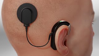 Cochlear Implant (3D Animation)