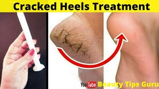 How To Fix Cracked Heels Permanently ||Cracked Heels Treatment