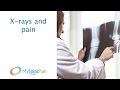 Osteoarthritis pain and x-rays