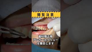 歯科矯正用アンカースクリューの撤去|歯列矯正|Removal of orthodontic anchor screws