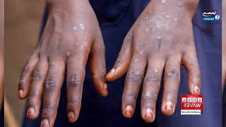 Over 800 Deaths as Mpox Epidemic Remains Uncontrolled in Africa