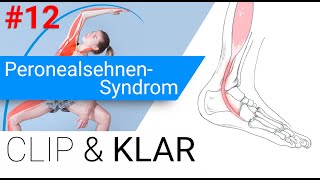 Peronealsehnen-Syndrom erklärt - Sehnenschädigung am Fuss-Aussenknöchel