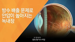 방수 배출 문제로 안압이 높아지는 녹내장 - (20140924_518회 방송)_당신의 눈이 멀고 있다 - 3대 실명(失明)질환