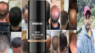 Spartan Root Activator Hair Growth Spray | Honest Review