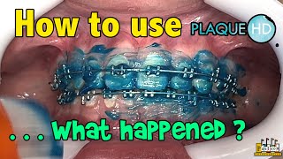 How to Use Plaque HD tooth paste with Braces -