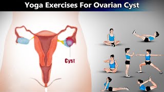 7 Yoga Poses for Ovarian Cyst