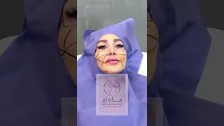 میخوای بدون میکاپ 💄صورتت جذاب باشه ( ماه زر )