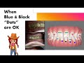 Invisalign ClinCheck - When blue and black dots are OK!