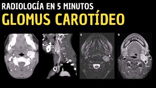 Radiología en 5 minutos: Glomus Carotídeo.