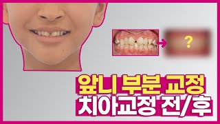 부산앞니부분교정 앞니만 유독 벌어지고 삐뚤다면? 필요한 부분만 부분교정으로 간단히!