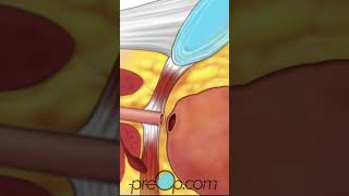 Laparoscopic Radical Prostatectomy - PreOp® Patient Education & Patient Engagement #shorts