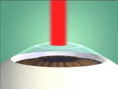 PRK - Photorefractive Keratectomy - YouTube