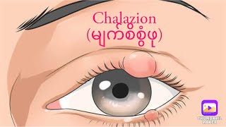 #မျက်စိစွံဖုအကြောင်း #Chalazion #eyes