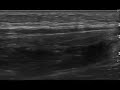 achilles tendon rupture ultrasound case