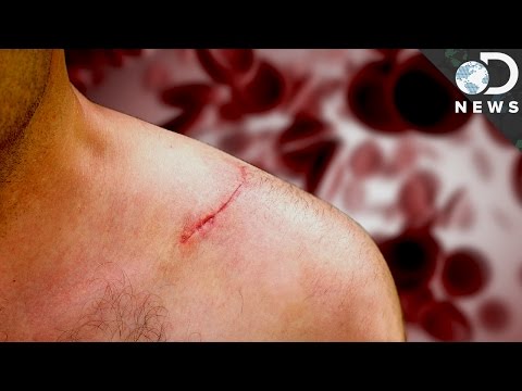 How Do Scars Form? How Do Scars Form?