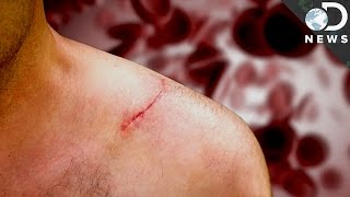 How Do Scars Form?