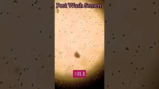 Pre Wash Vs Post Wash Semen #IUI #iuisample #drshubhipatil  #infertilitytreatment #iuisuccess