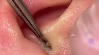 GIANT EAR WAX REMOVAL 巨型耳朵粉刺 黑頭粉刺-귀지 제거-kulak kiri temizleme