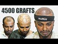 Hair Transplant for Grade 5 Baldness 😃 | Hair Transplant Kolkata | New Roots