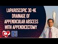 Laparoscopic 3D 4K drainage of Appendicular abscess with Appendicectomy.