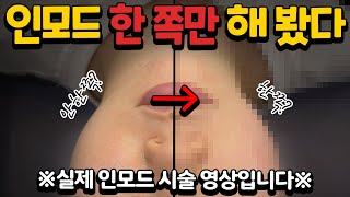 🚨인모드 실제 시술 영상🚨 인모드를 한 쪽만 하면 생기는 일?!