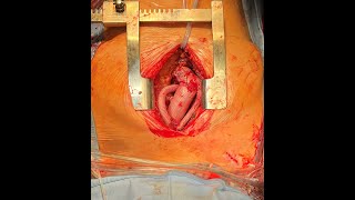 AORTIC VALVE REPLACEMENT, FROZEN ELEPHANT TRUNK, DEBRANCHING PROCEDURE, EPIA-AORTIC VESSELS