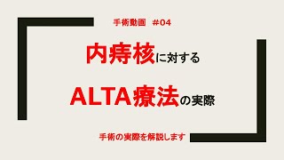 No.04 内痔核の手術の実際をお送りします。　#ALTA療法　#いぼ痔　#肛門