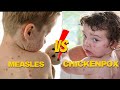 Understanding the Differences Between Measles and Chickenpox