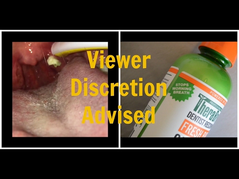 Get Rid Of Tonsil Stones & Morning Breath 😷 Get Rid Of Tonsil Stones & Morning Breath 😷