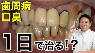 セラミック矯正で歯周病・口臭も治った！