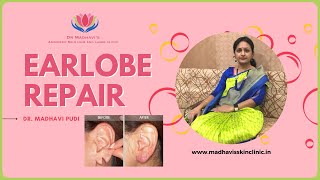 Earlobe Repair | Dermatologist | Skin care center and hair clinic | Dr. Madhavi's skin clinic