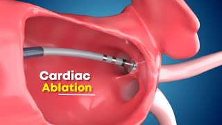 Cardiac Ablation (surgery) 3D Animation