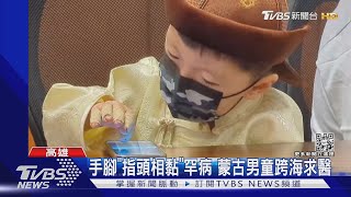 手腳「指頭相黏」罕病 蒙古男童跨海求醫｜TVBS新聞