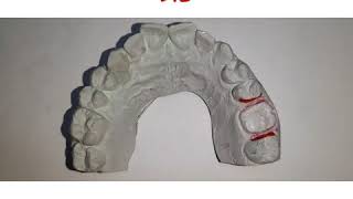 DIES AND DIE SYSTEMS IN FIXED PROSTHODONTICS