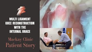 Multi Ligament knee reconstruction with the InternalBrace - Patient Story