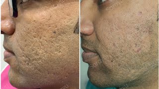 Acne Scar Treatment Fractional CO2 Laser, Subcision, MnRF with Vampire Facial(Face PRP) #Short