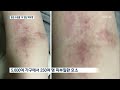 평택 아파트 단지서 피부병 집단 발병…붉은 수돗물 탓 kbs뉴스 news