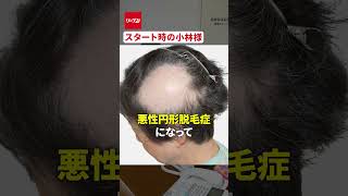 岡村社長に突撃！発毛日本一コンテスト出場者小林様について #リーブ21 #育毛 #岡村社長 #発毛 #発毛塾 #抜け毛 #薄毛 #髪の毛 #発毛コンテスト