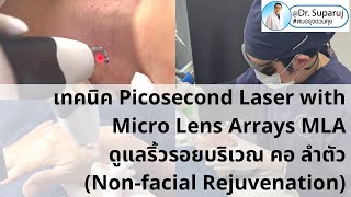 เทคนิคการใช้เลเซอร์ Picosecond Laser with Micro Lens Arrays MLA เพื่อดูแลริ้วรอยบริเวณ คอ ลำตัว