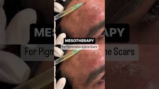 Mesotherapy for Acne Scars